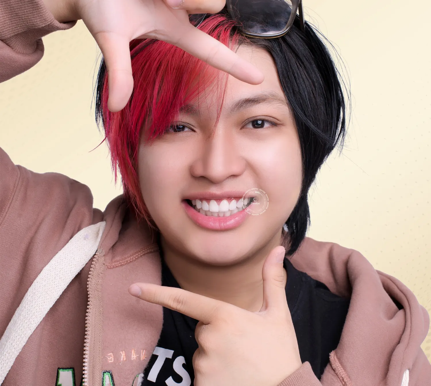 Dán Veneer Dentos: Nâng tầm nụ cười - Không còn sợ rủi ro